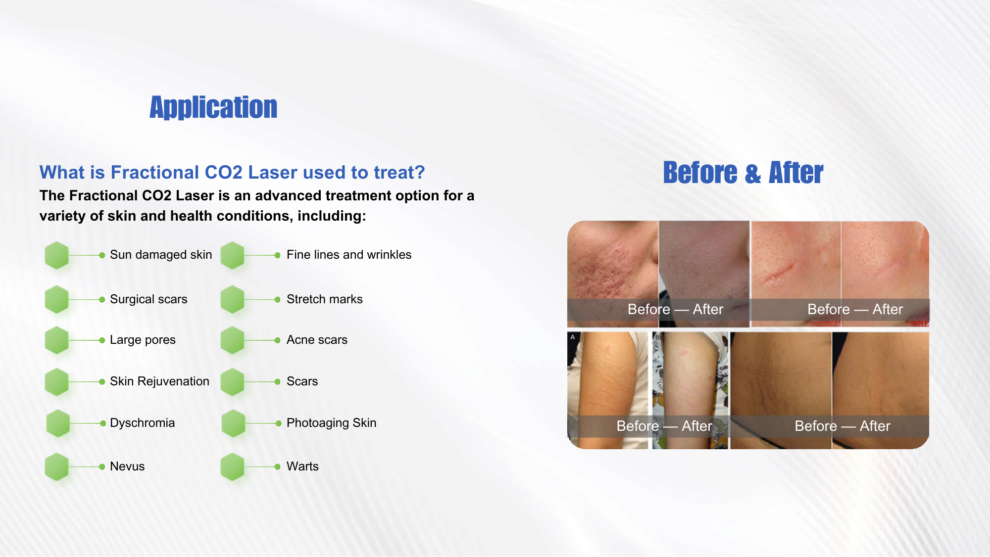 CarbonX CO2 Laser before and after clinical results — acne scarring, stretch marks, skin rejuvenation